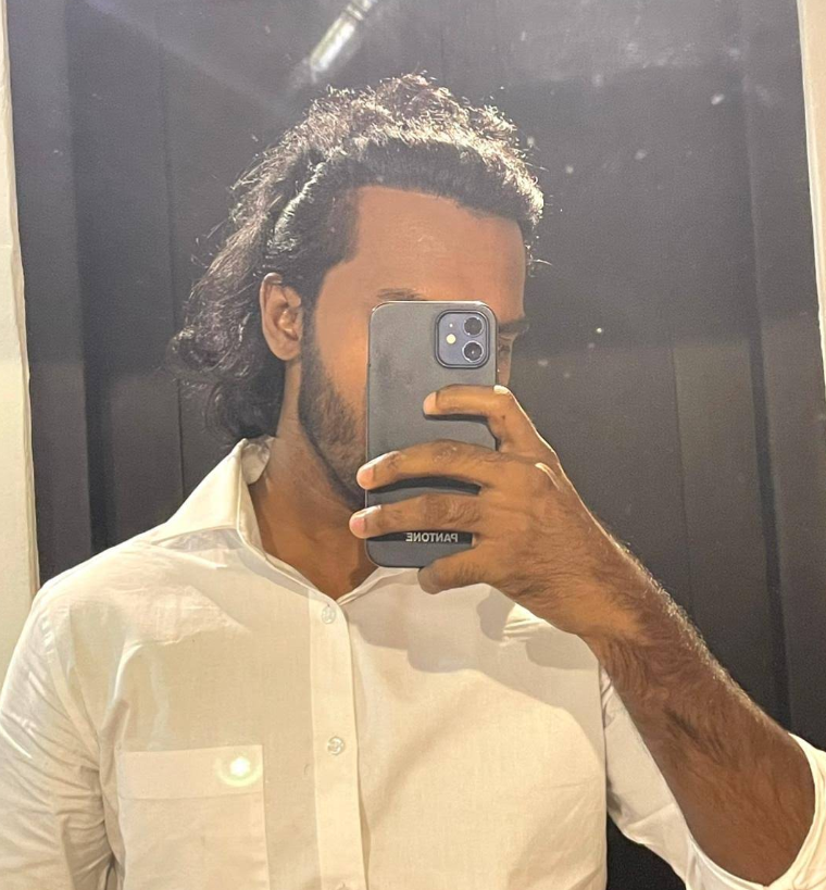 Pasindu Upeka DHI hair transplant